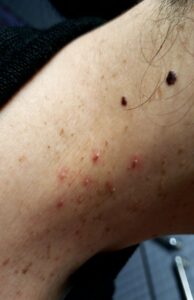 首のぶつぶつに液体窒素を塗布