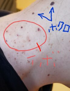 液体窒素で治療中の首イボ