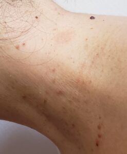 首の左側のぶつぶつを液体窒素で治療中